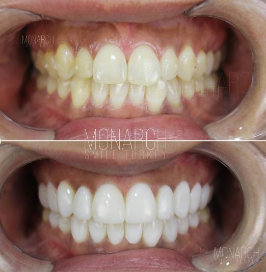 Composite-Bonding-Before-After in turkey, antalya