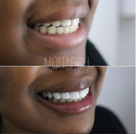 composite-bonding-5-before-after-antalya