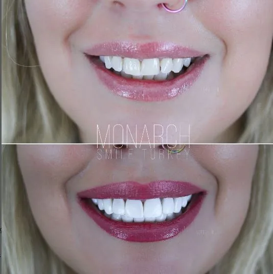 composite-bonding-3-before-after-antalya-turkey