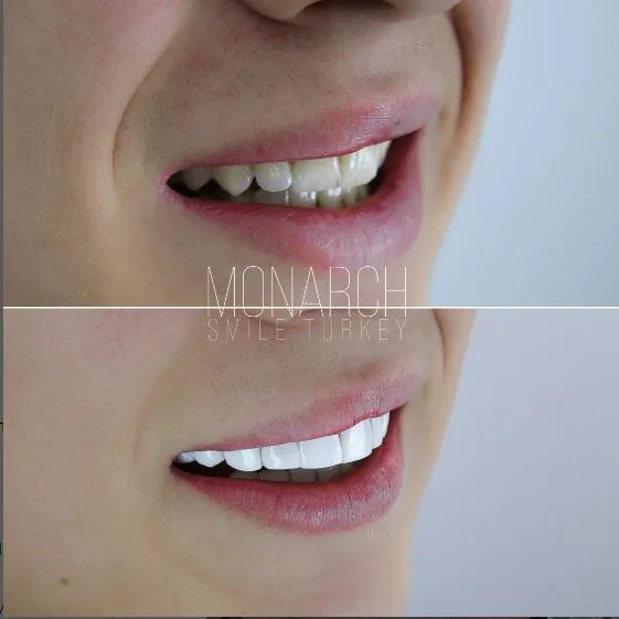 composite-bonding-5-before-after-antalya