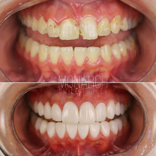 Smile Makeover Composite Bonding with natural textures. in turkey, antalya