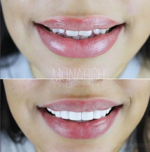 composite-bonding-3-before-after-2-antalya-turkey