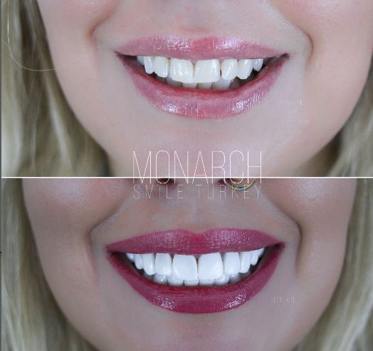 Dazzling smile with composite bonding-antalya-10 top row and 10 bottom row