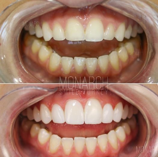 composite-bonding-before-and-after-turkey-antalya