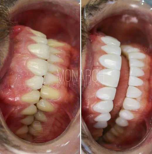 composite-bonding-before and after photos