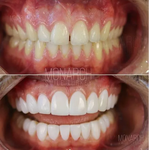 composite-bonding-before and after photos