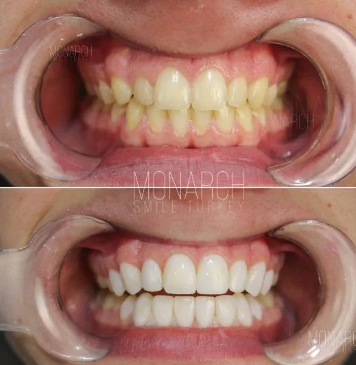composite-bonding-before and after photos