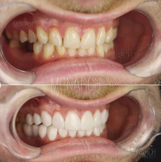 composite-bonding-before and after photos
