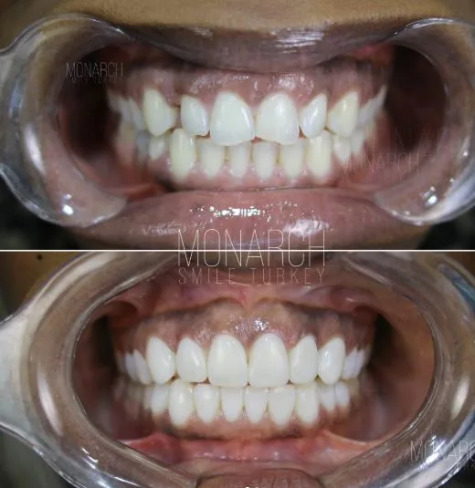 composite-bonding-before and after photos