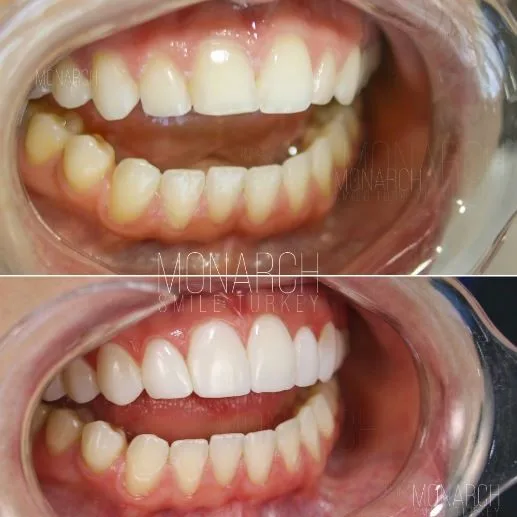 composite-bonding-before and after photos