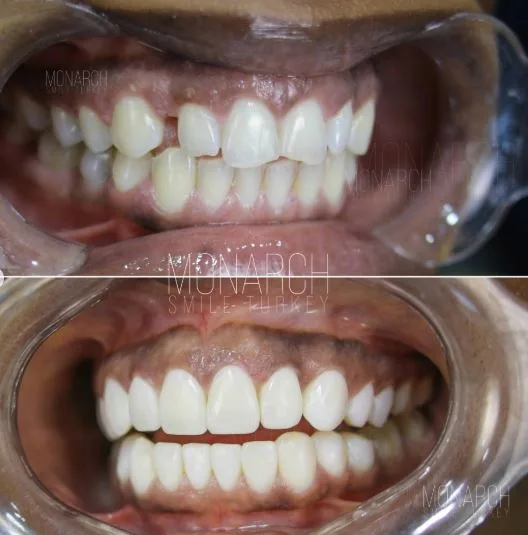composite-bonding-before and after photos