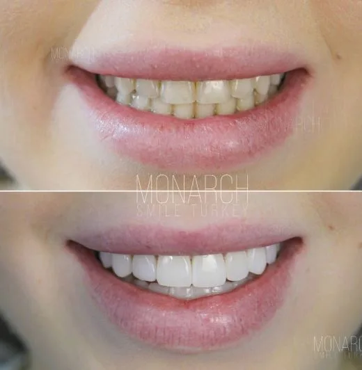 NATURAL COMPOSITE BONDING CASE
