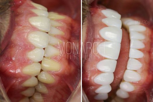 how-much-are-composite-bonding-teeth-cost-turkey-antalya