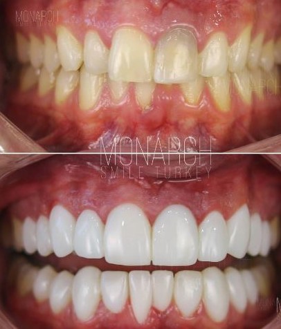 Composite Bonding Veneers Price in Turkey