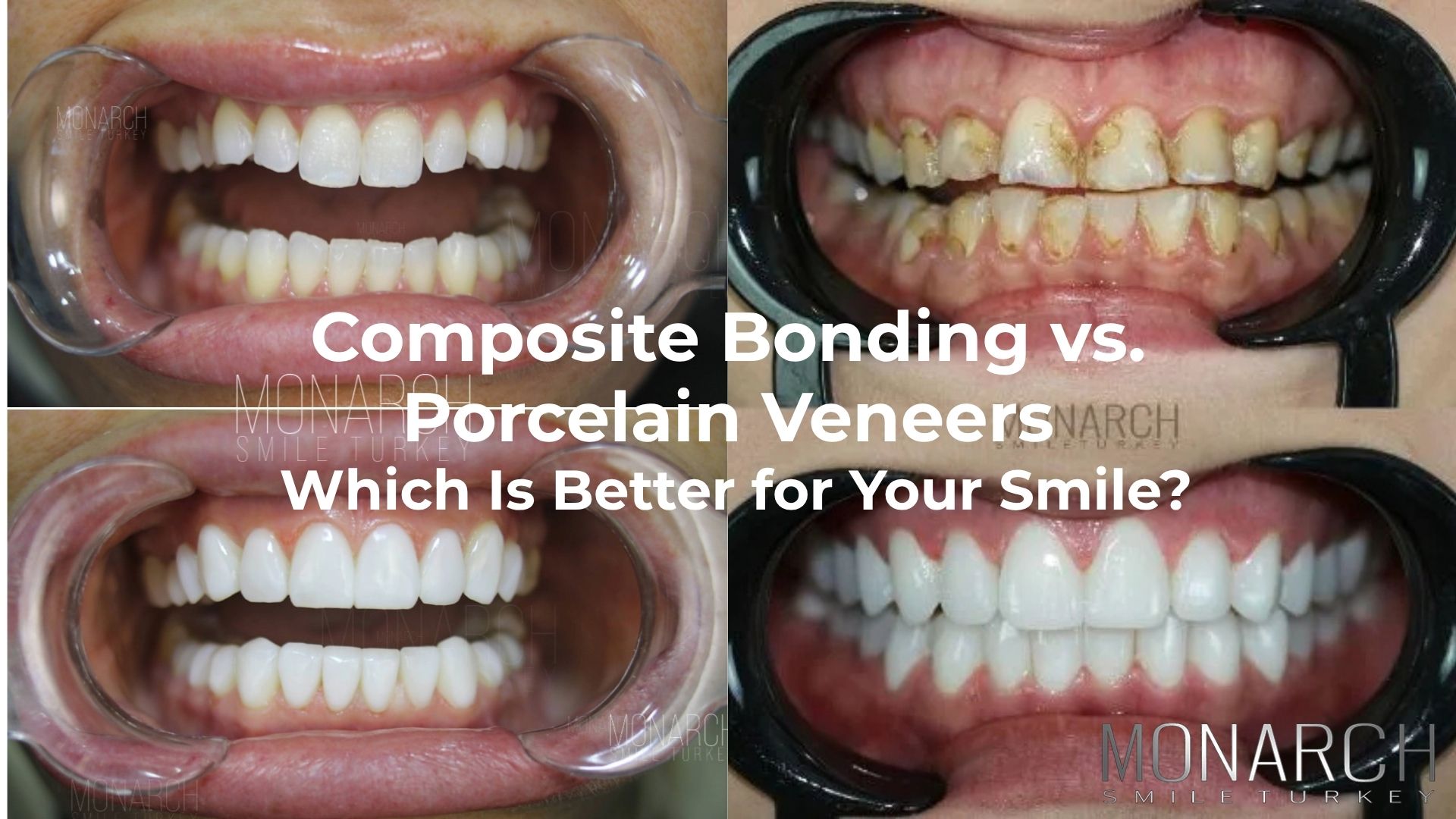 Composite bonding vs Porcelain veneers in Antalya, Turkey