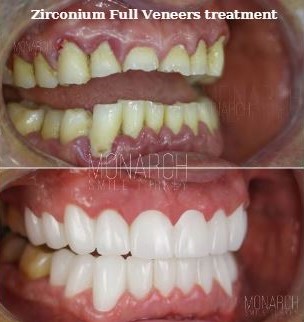 Zirconium Full Veneers treatment in turkey, antalya