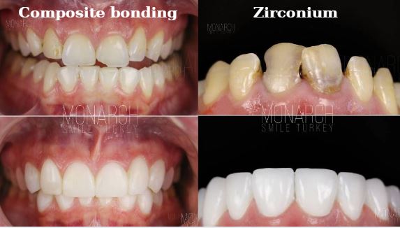 Which is better, composite bonding or veneers?