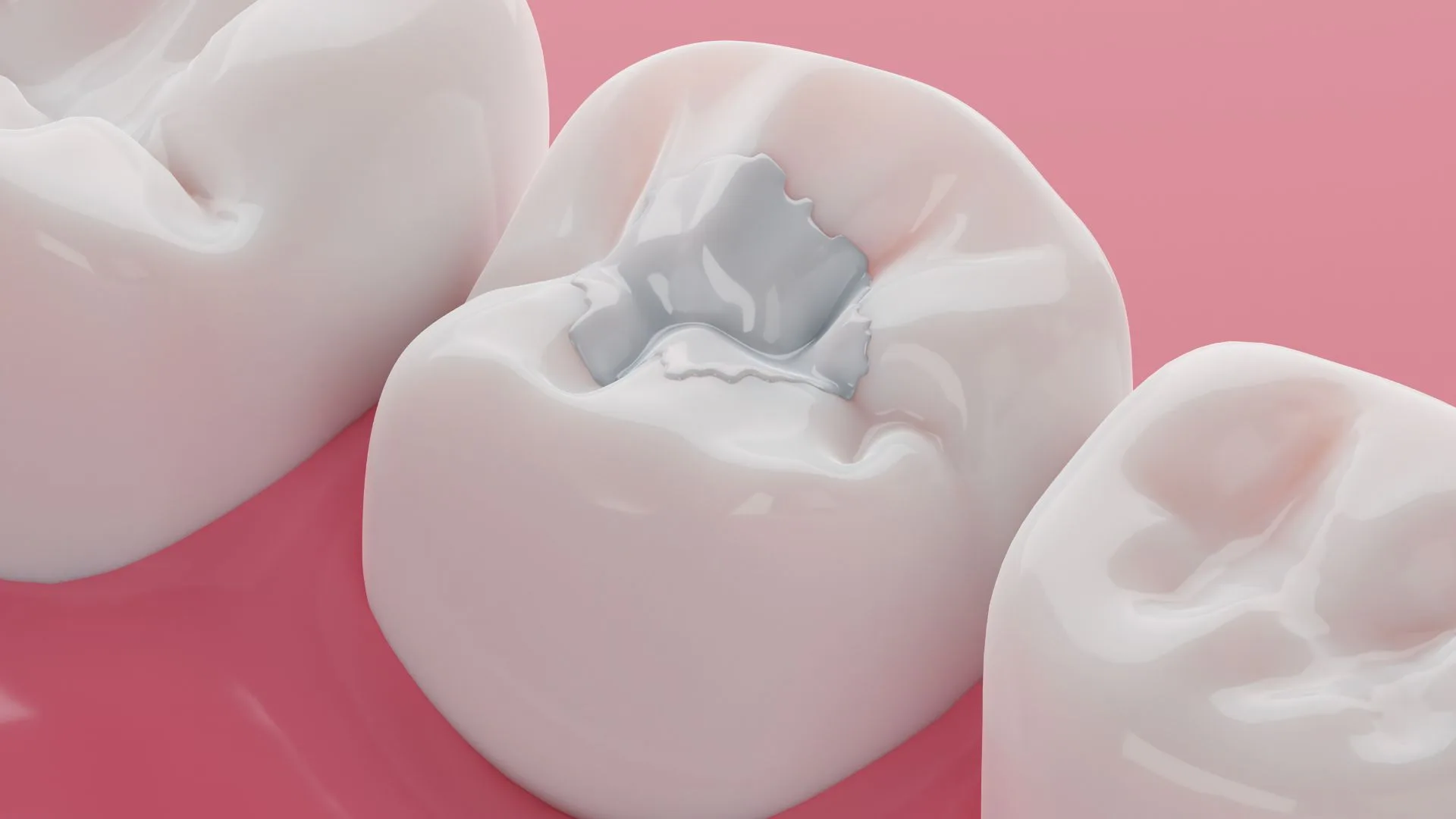 bonding-implant-antalya