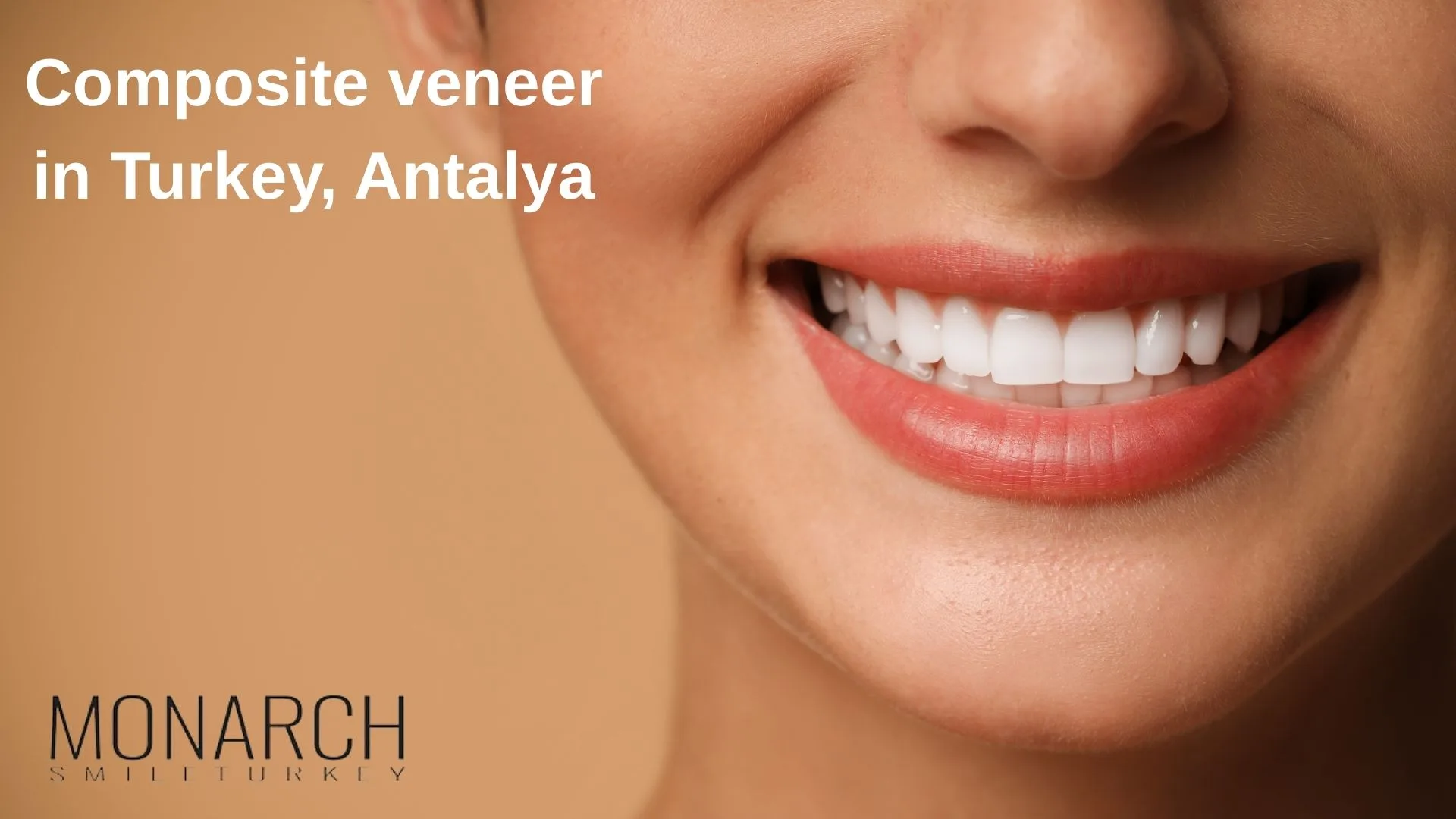 composite-veneer-turkey-antalya