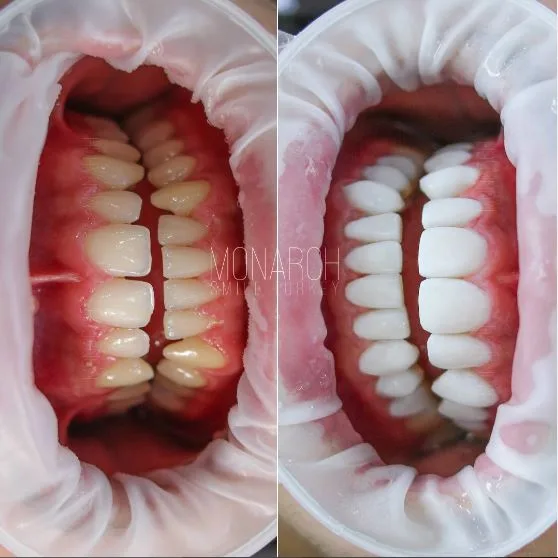 Can you whiten composite bonding?-antalya turkey