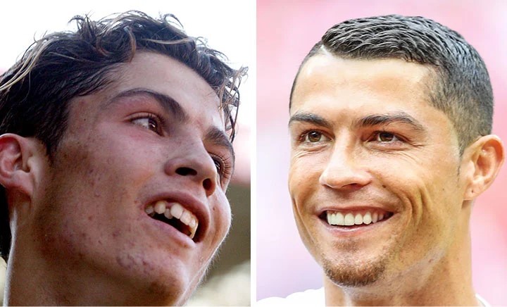celebrities-with-veneers-Cristiano Ronaldo celebrities-with-veneers-Cristiano Ronaldo