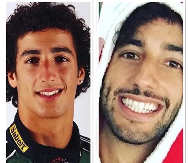 celebrities-with-veneers-Daniel Ricciardo celebrities-with-veneers-Daniel Ricciardo