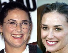 celebrities-with-veneers-demi-moore celebrities-with-veneers-demi-moore