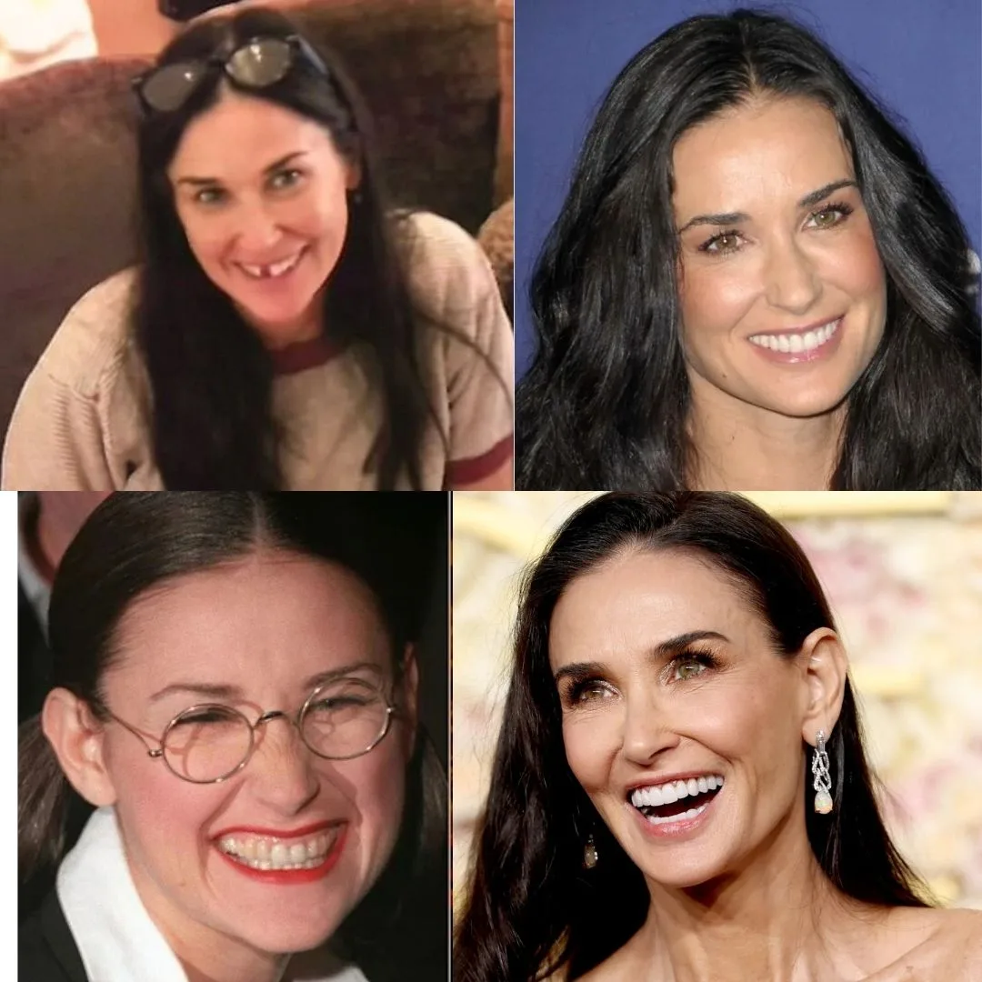 Demi Moore New Teeth Now: Before and After Demi Moore New Teeth Now: Before and After