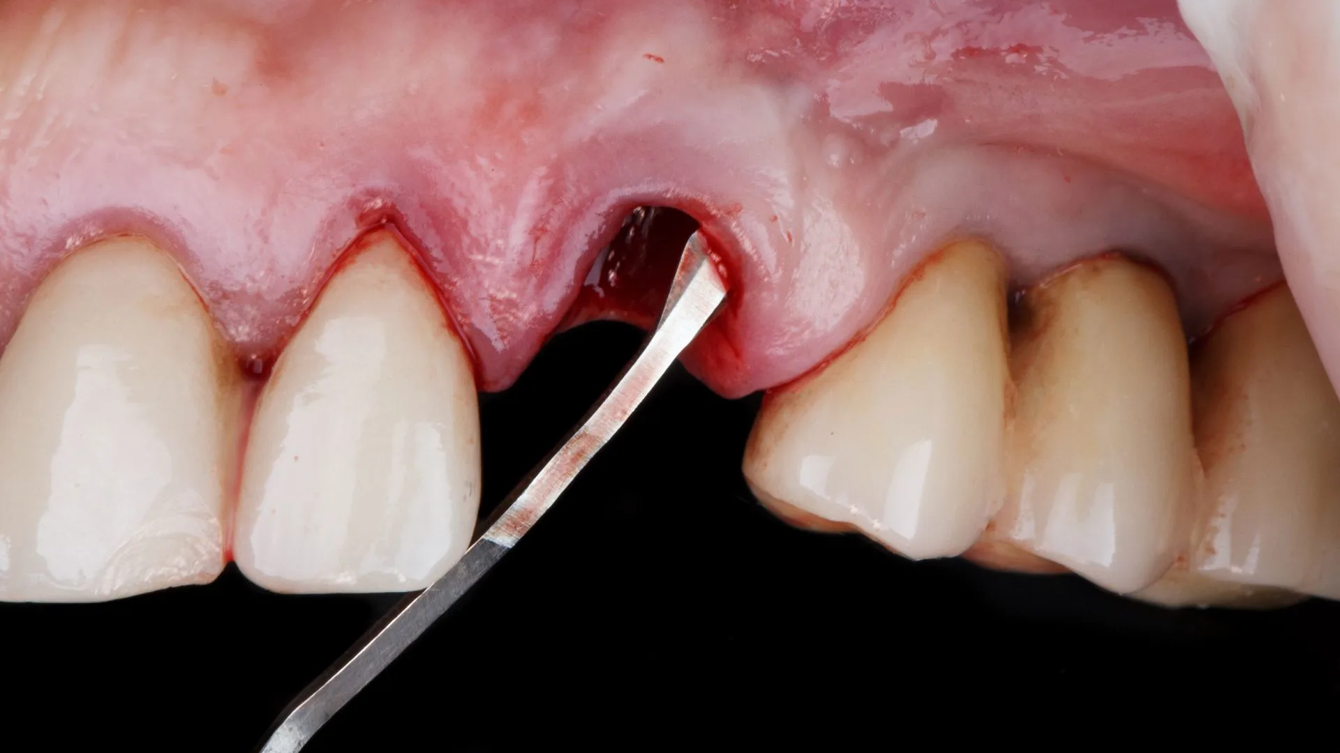 dental-bone-grafting-antalya, turkey