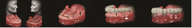 All teeth losses