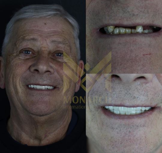 How successful are dental implants? in Turkey, Antalya