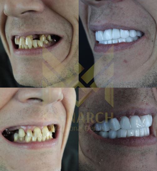 who is suitable for Dental Teeth Implants in Turkey, Antalya