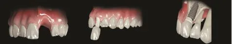 Loss of a single tooth