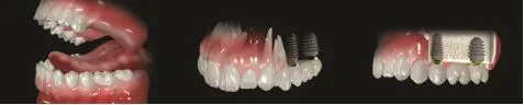 Multiple teeth losses
