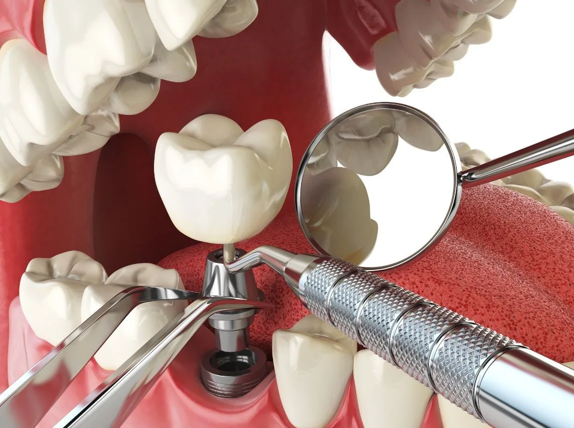 Dental Impant Treatment in Turkey, Antalya