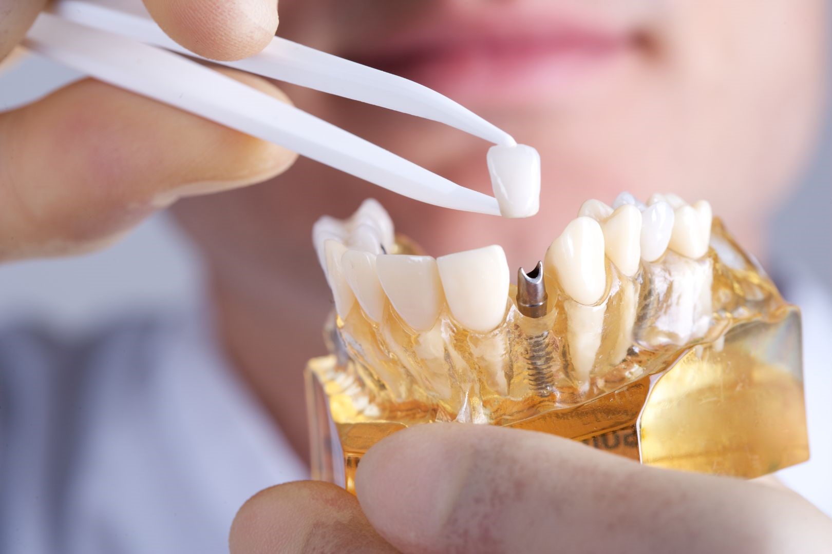 Is it Safe to Go to Turkey for Dental Implants? antalya