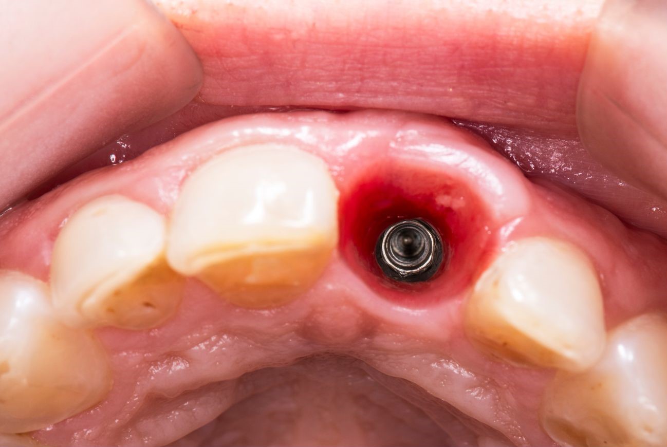 what-is-the-process-of-a-single-tooth-implant-turkey