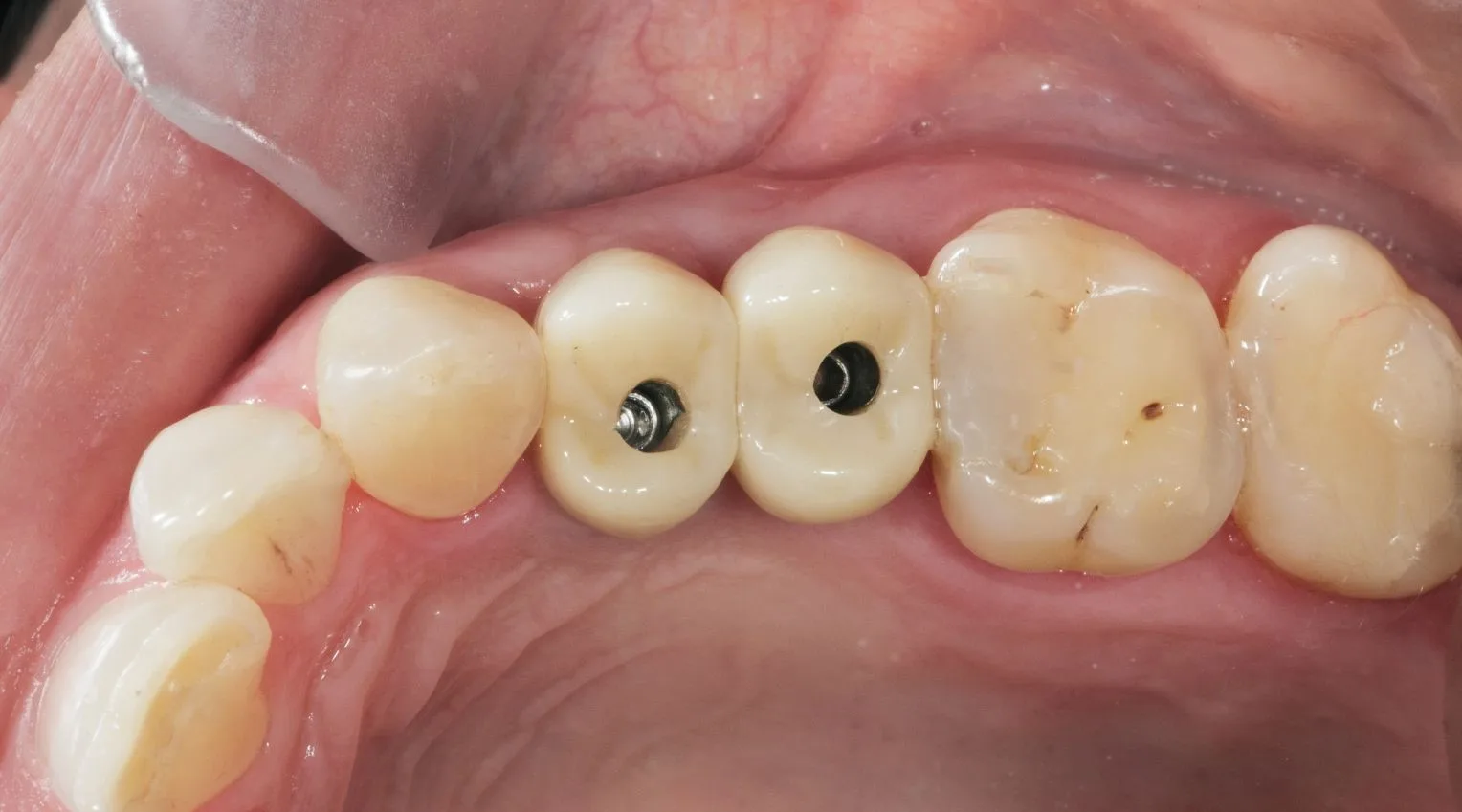 Third Stage of Dental Impant Treatment in Turkey, Antalya