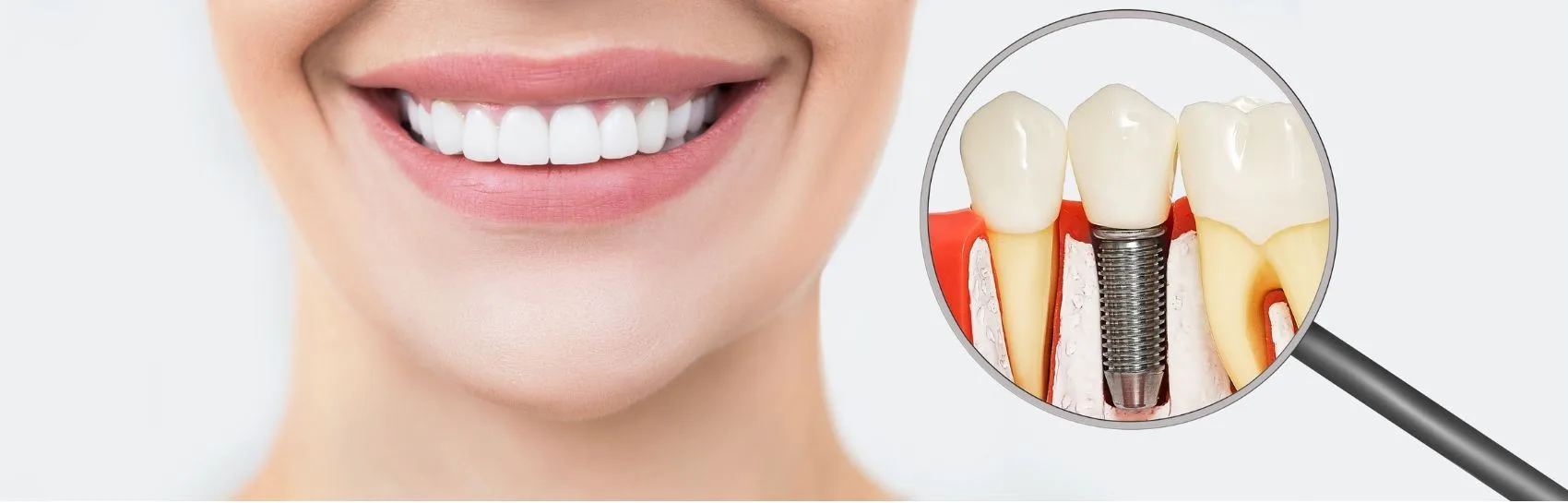 dental-implant-treatment-stages-antalya-turkey