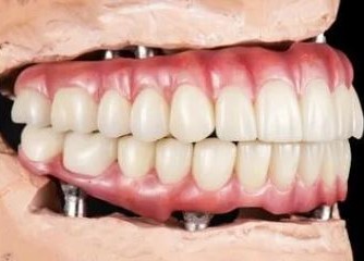 All on Four Dental Implants