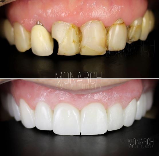 what-are-the-methods-and-techniques-of-dental-implants-turkey