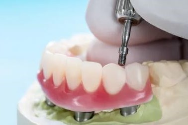 Implant Supported Dentures