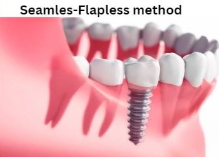 Seamless implant - Flapness implant