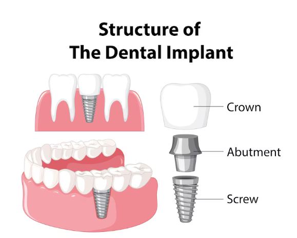 dental-implant-type-screw