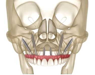 Zygomatic Implants