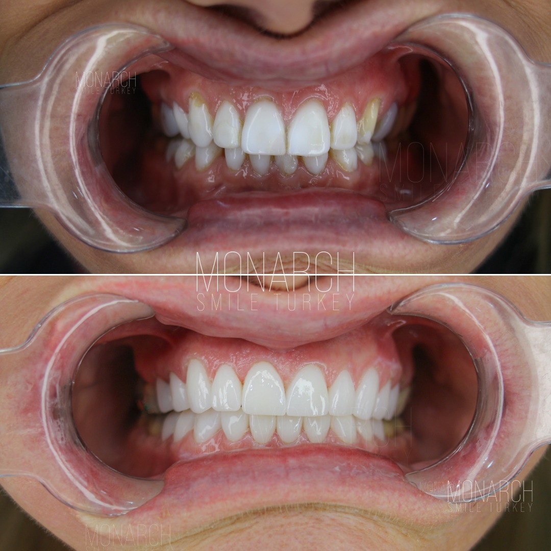 dental-veneer-turkey-11