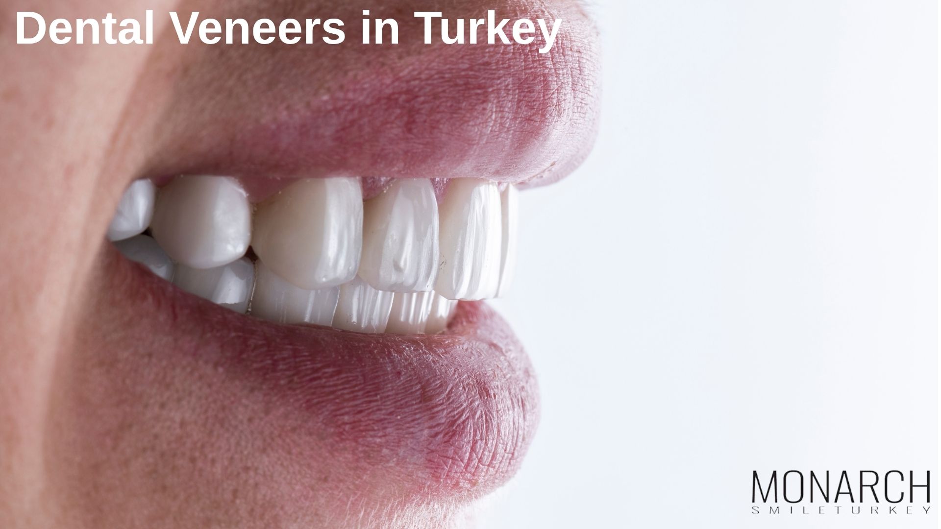 Veneers Teeth Before and After in Turkey, Antalya Veneers Teeth Before and After in Turkey, Antalya