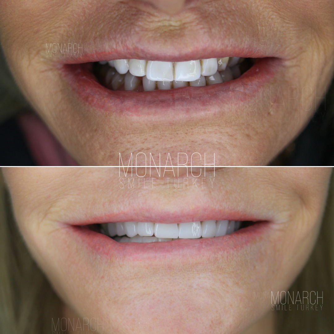 emax veneer before and after-1