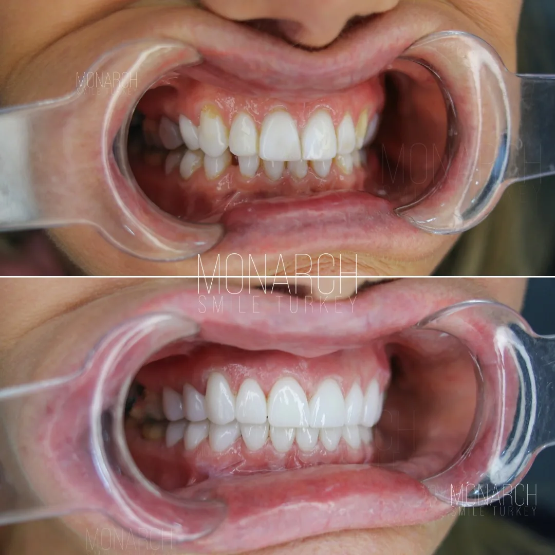 emax veneer before and after-3