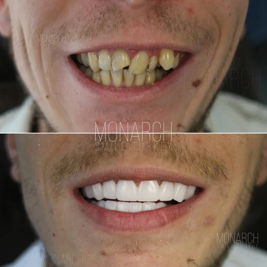 emax veneer before and after-1